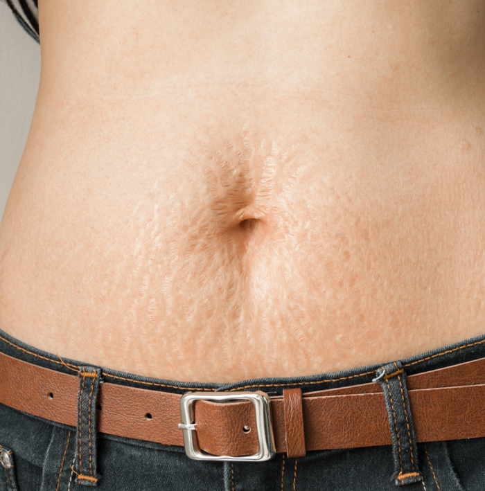 Vergetures post-accouchement : comment leur faire la peau ?