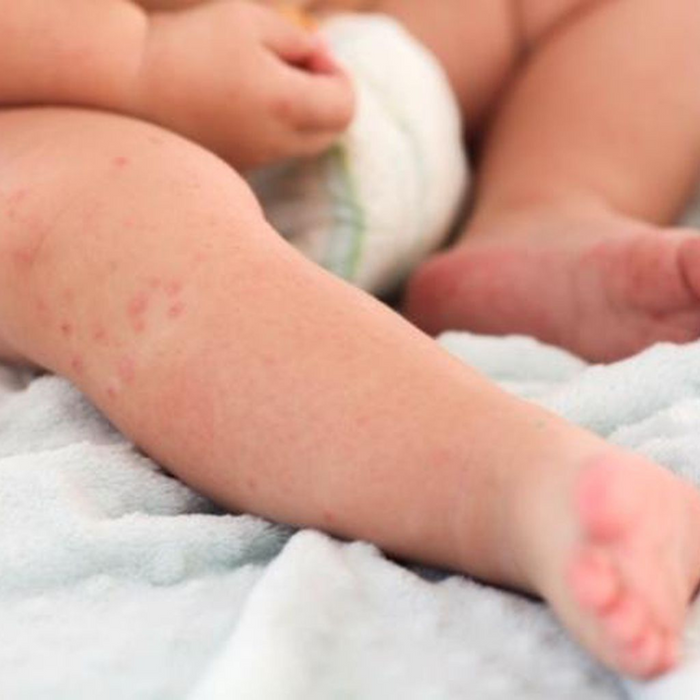 Tout savoir sur les boutons de chaleur du bébé