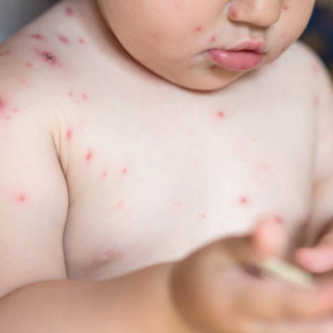 Varicelle : comment se soigne cette maladie infantile ?